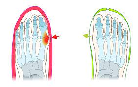 Hallux Valgus mit Barfuß-Schuhen verhindern und weniger Schmerzen beim Laufen